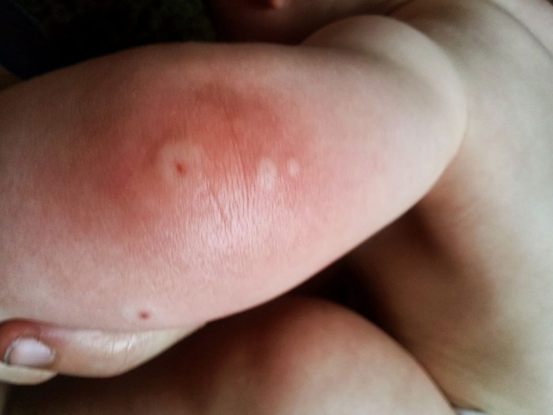 Cách sơ cứu khi bị ong vò vẽ đốt 2