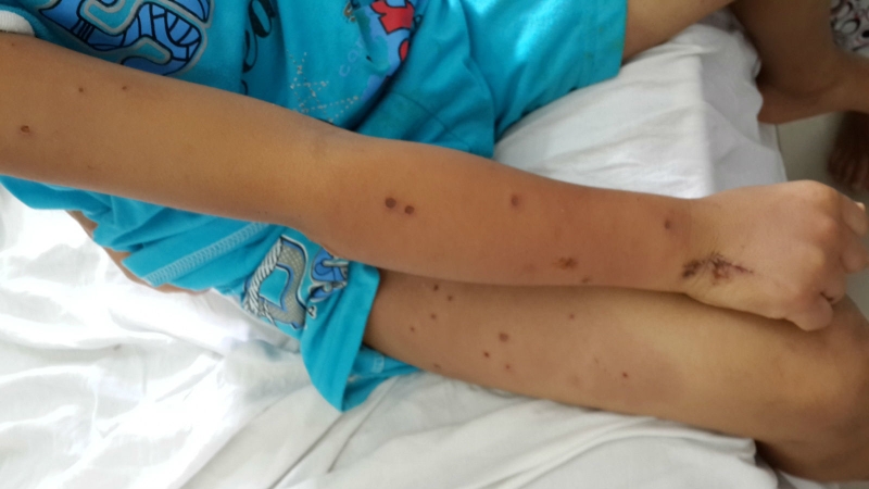 Sưng nề do ong vò vẽ đốt 4