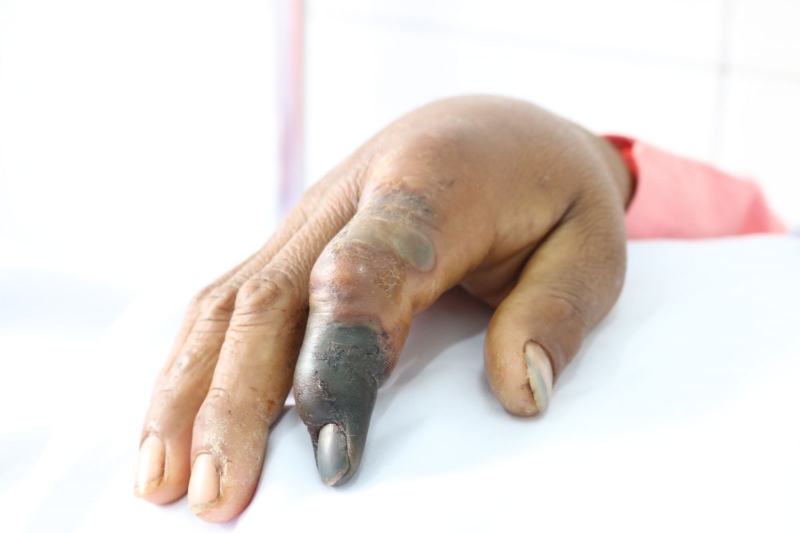 Sơ cứu khi bị rắn hổ mang cắn như thế nào 2