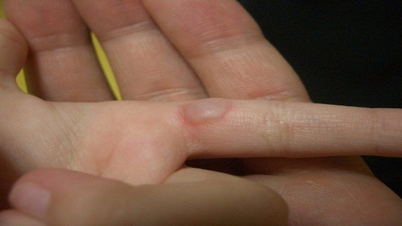 Cách sơ cứu hiệu quả khi bị bỏng hơi nước 2