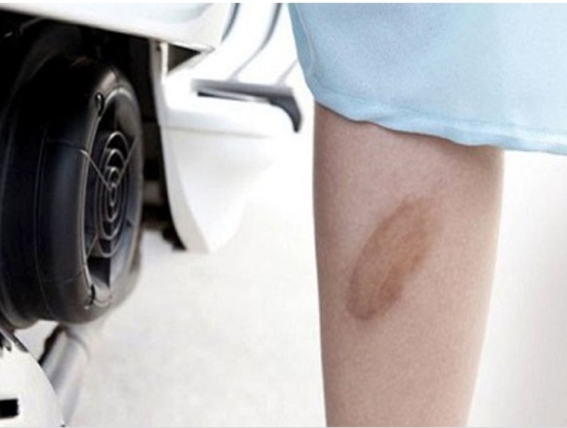 Hướng dẫn sơ cứu phỏng bô xe 1