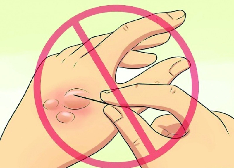 Hướng dẫn sơ cứu phỏng bô xe 3