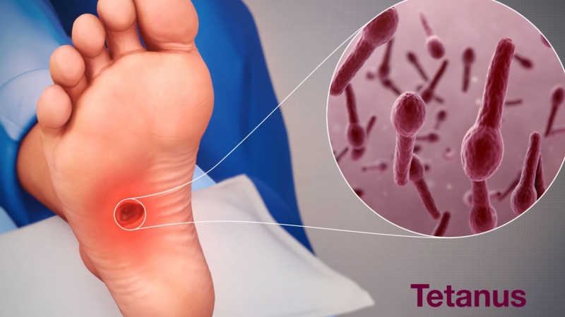 Sơ cứu uốn ván và những điều cần biết 1