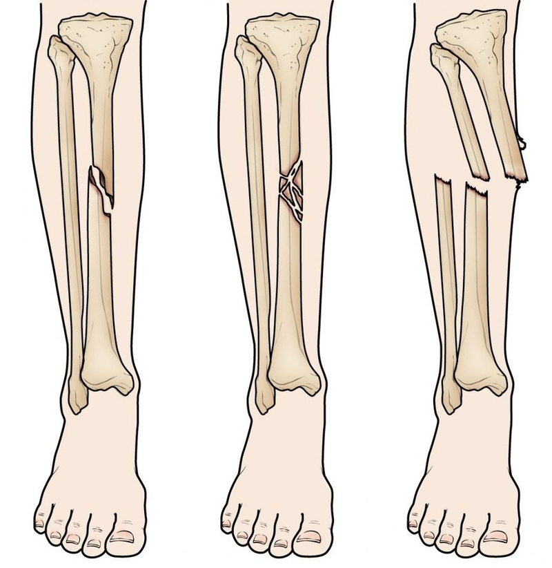Sơ cứu và băng bó cho người bị gãy xương thế nào là chính xác 1