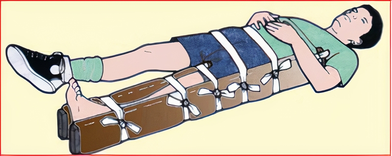 Sơ cứu và băng bó cho người bị gãy xương thế nào là chính xác 4