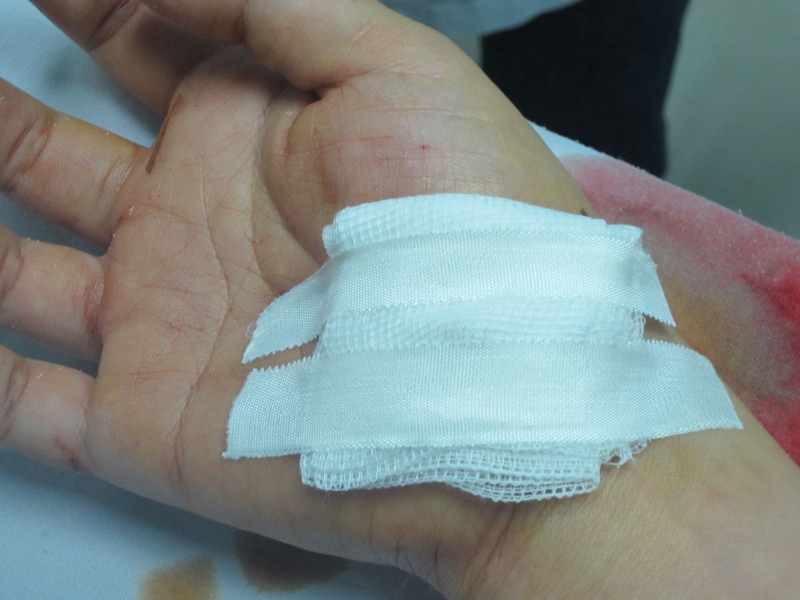 Sơ cứu vết thương ở lòng bàn tay 1