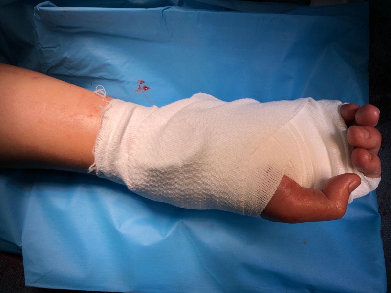 Sơ cứu vết thương ở lòng bàn tay 2