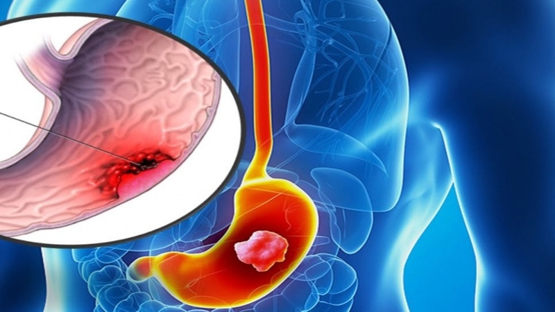 Sơ cứu xuất huyết dạ dày 1