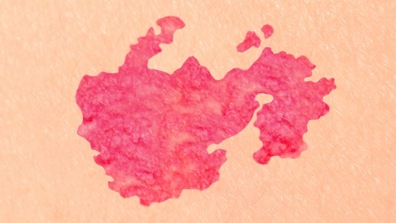 So sánh bớt rượu vang và bớt cá hồi: Cha mẹ cần biết gì? 1