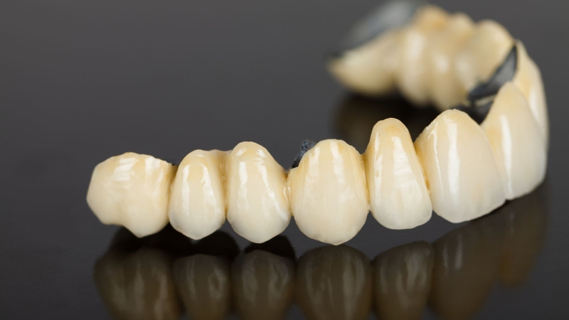 So sánh các loại răng sứ: Nên chọn loại nào cho phù hợp? 1