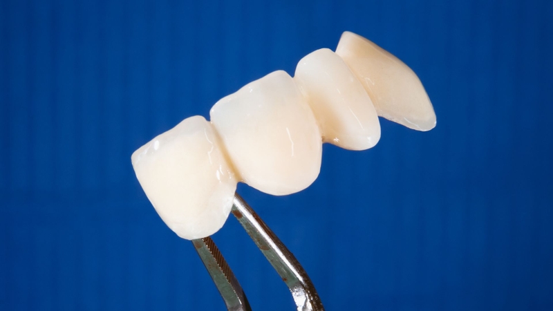 So sánh các loại răng sứ: Nên chọn loại nào cho phù hợp? 3