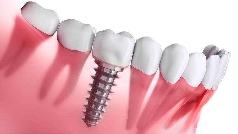 So sánh các loại trụ Implant 1