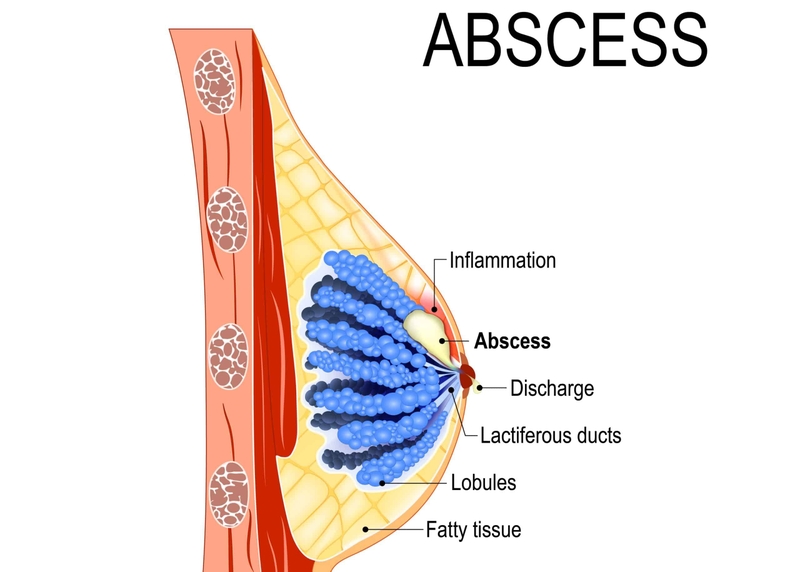 So sánh kỹ thuật chích rạch và kỹ thuật chọc hút dẫn lưu áp xe vú 2