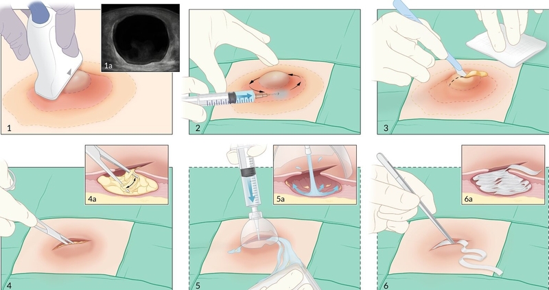 So sánh kỹ thuật chích rạch và kỹ thuật chọc hút dẫn lưu áp xe vú 3