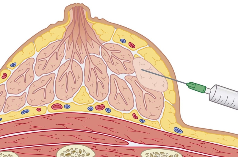 So sánh kỹ thuật chích rạch và kỹ thuật chọc hút dẫn lưu áp xe vú 4