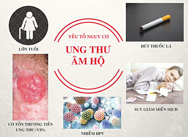 Sổ tay hướng dẫn điều trị ung thư âm hộ 1
