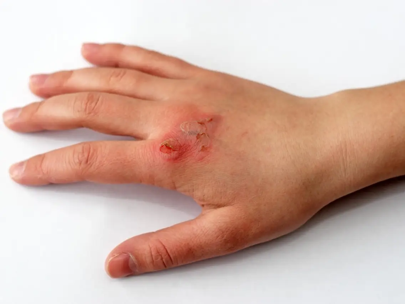 Sốc điện là gì? Cách xử lý khi nạn nhân bị sốc điện do điện giật 1