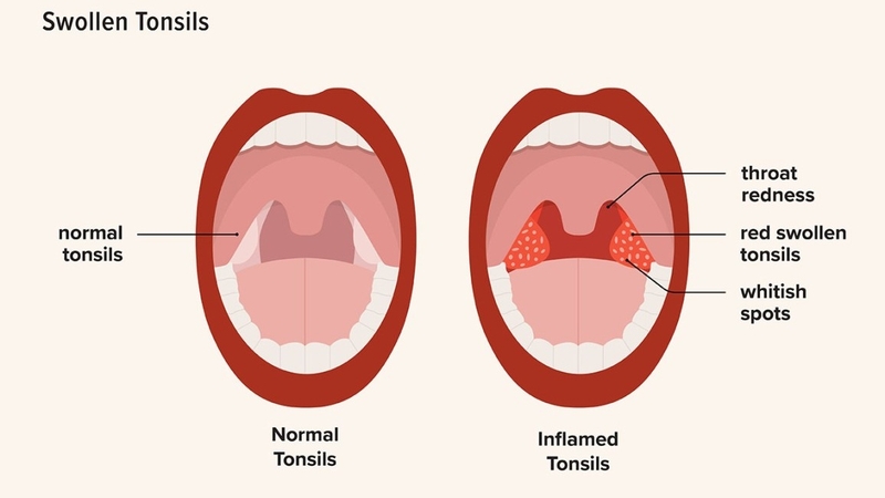 Sỏi amidan có tự khỏi không? Có gây ra biến chứng gì không? 1