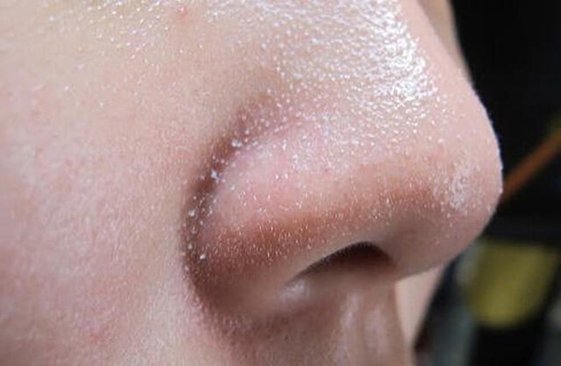 Sợi bã nhờn để làm gì? 5 cách giúp bạn loại bỏ sợi bã nhờn1