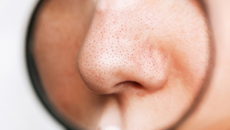 Sợi bã nhờn là gì? Nguyên nhân và cách trị sợi bã nhờn hiệu quả 3