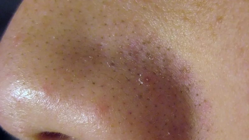 Sợi bã nhờn là gì? Nguyên nhân và cách trị sợi bã nhờn hiệu quả 1