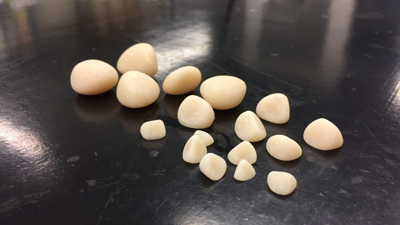 Sỏi bàng quang 7mm là lớn hay nhỏ? Có nguy hiểm không? 1