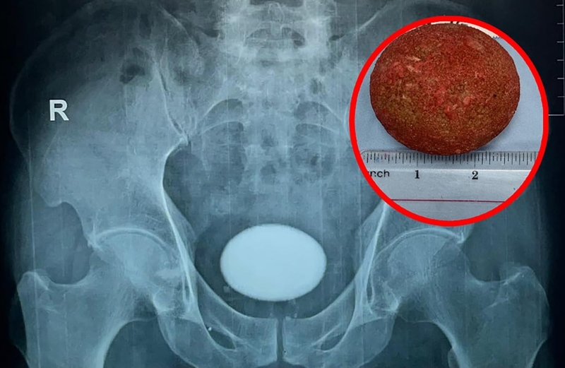 Sỏi bàng quang uống gì? Top 5 những thức uống tốt cho người sỏi bàng quang 1