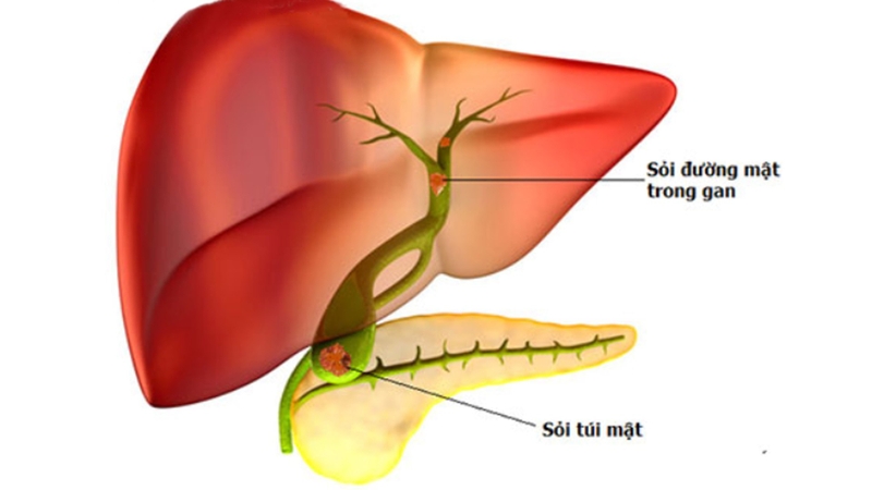Sỏi đường mật trong gan nguy hiểm như thế nào?-2