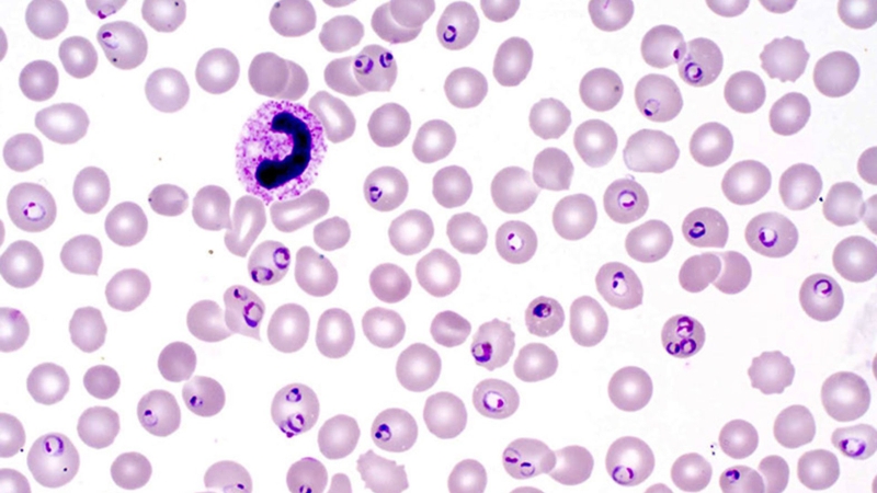 Soi ký sinh trùng sốt rét là phương pháp được sử dụng phổ biến trong chẩn đoán bệnh