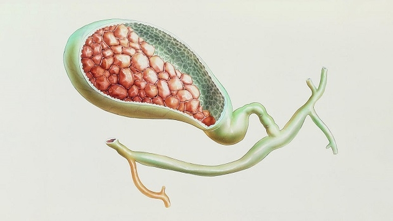 Sự xuất hiện của sỏi mật làm cản trở dòng chảy của dịch