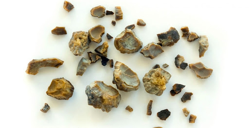 Những thông tin chia sẻ về sỏi mật khác sỏi thận mà bạn cần biết