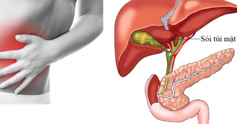 Những điều bạn cần biết về bệnh sỏi mật ở phụ nữ 3