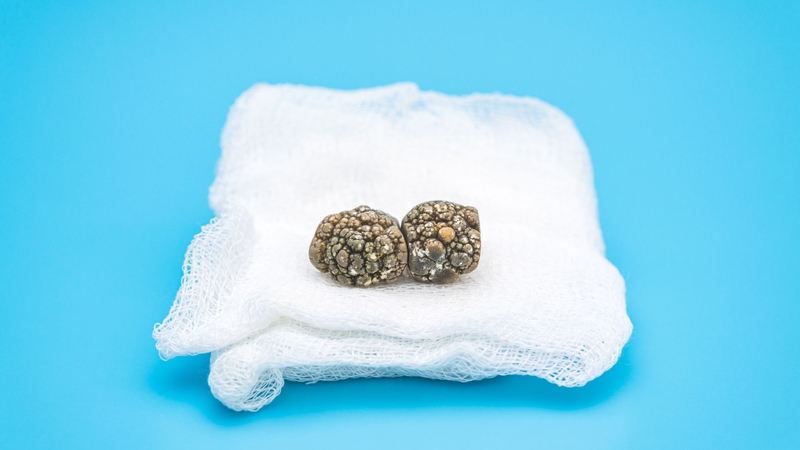 Sỏi mật uống thuốc có tan không? Một số loại thuốc làm tan sỏi phổ biến hiện nay 2