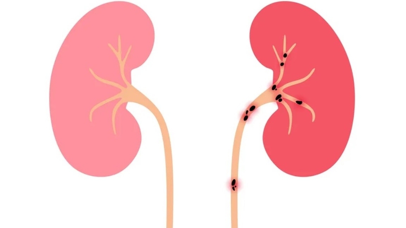 Sỏi niệu quản 1/3 dưới 6mm là gì và chữa như thế nào? 1
