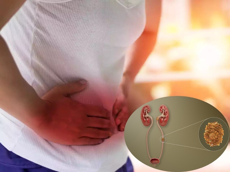 Sỏi niệu quản có nguy hiểm không? Cảnh giác với những biến chứng 3