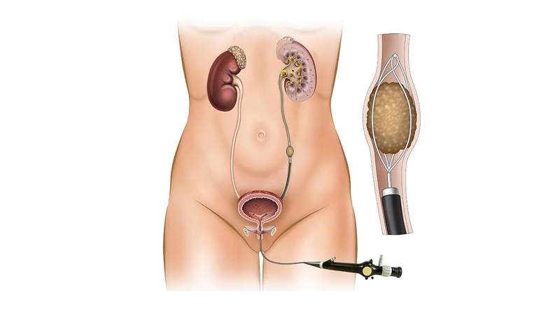 Sỏi niệu quản có tái phát không? Vì sao? 2