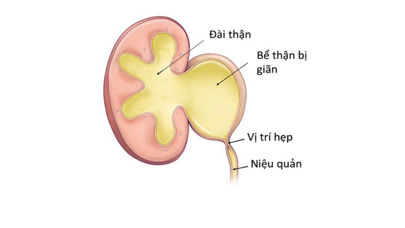 Sỏi niệu quản đoạn sát thành bàng quang điều trị như thế nào? 2