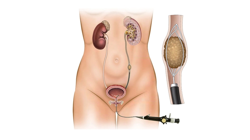 Sỏi niệu quản đoạn sát thành bàng quang điều trị như thế nào? 3