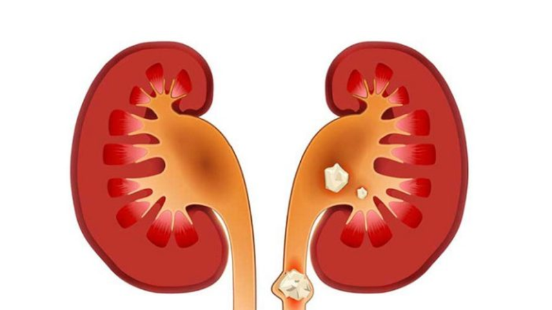 Sau khi tán sỏi niệu quản nên kiêng gì? 1