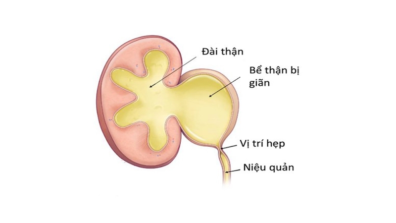 Sỏi niệu quản nội thành bàng quang là gì? Cách điều trị 1