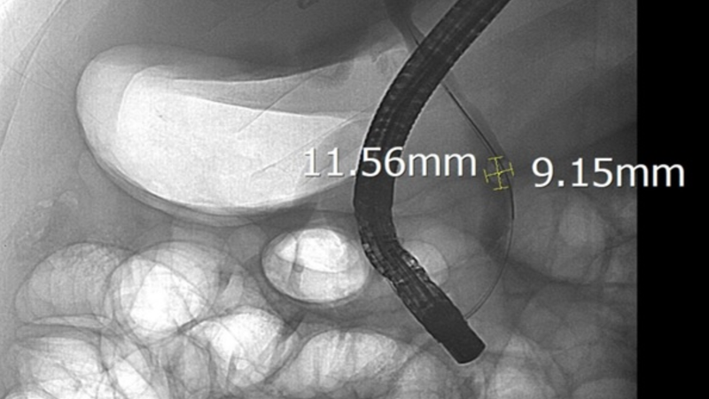 Viên sỏi có kích thước lên tới 11,5 x 9 mm