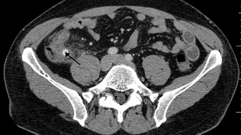 Sỏi phân là tình trạng khá phổ biến xong thường bị bỏ qua