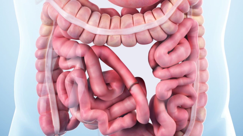 Sỏi phân có thể dẫn đến tắc ruột cấp tính nếu không được điều trị kịp thời