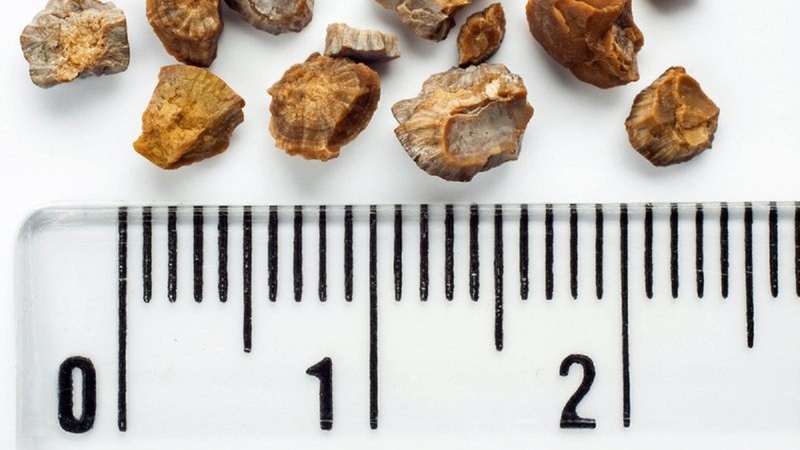 Sỏi thận 7mm là to hay nhỏ, có nguy hiểm không? 2