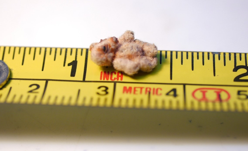 Sỏi thận 9mm có nguy hiểm không? Lưu ý khi trị sỏi thận 2