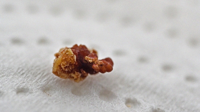 Sỏi thận acid uric và cách điều trị hiệu quả 1