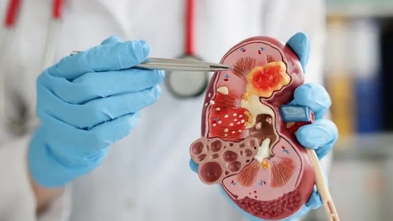 Sỏi thận bao nhiêu mm thì phải mổ?