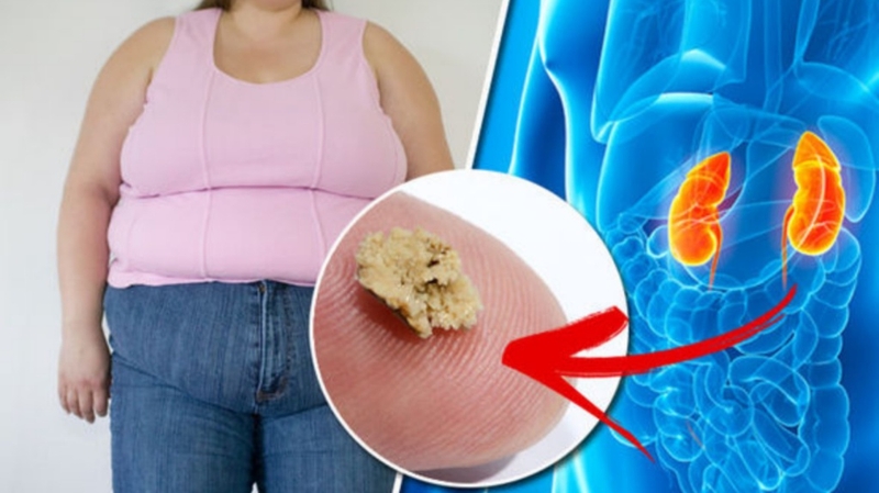 Sỏi thận có di truyền không?
