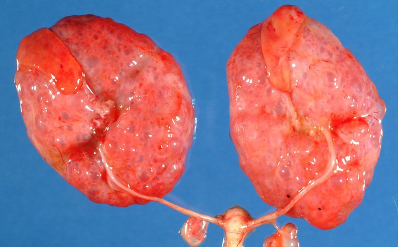 Sỏi thận gây ứ nước - bệnh lý nguy hiểm không được chủ quan1