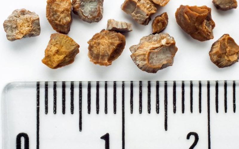 Sỏi thận kích thước bao nhiêu là to và cần phải phẫu thuật? 2